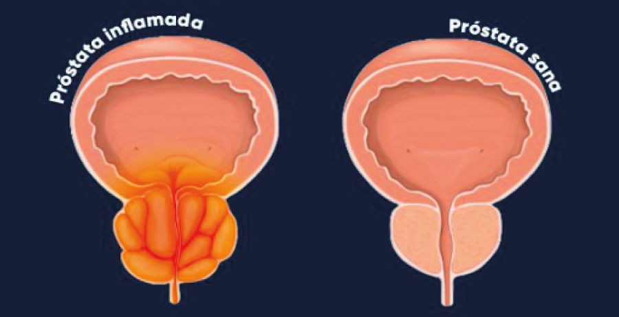 Consells per els problemes de prostata